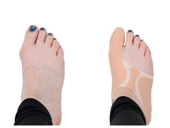 Hallux Valgus Splint before and after